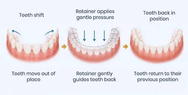 Illustration showing how a retainer can move slightly shifted teeth back into alignment