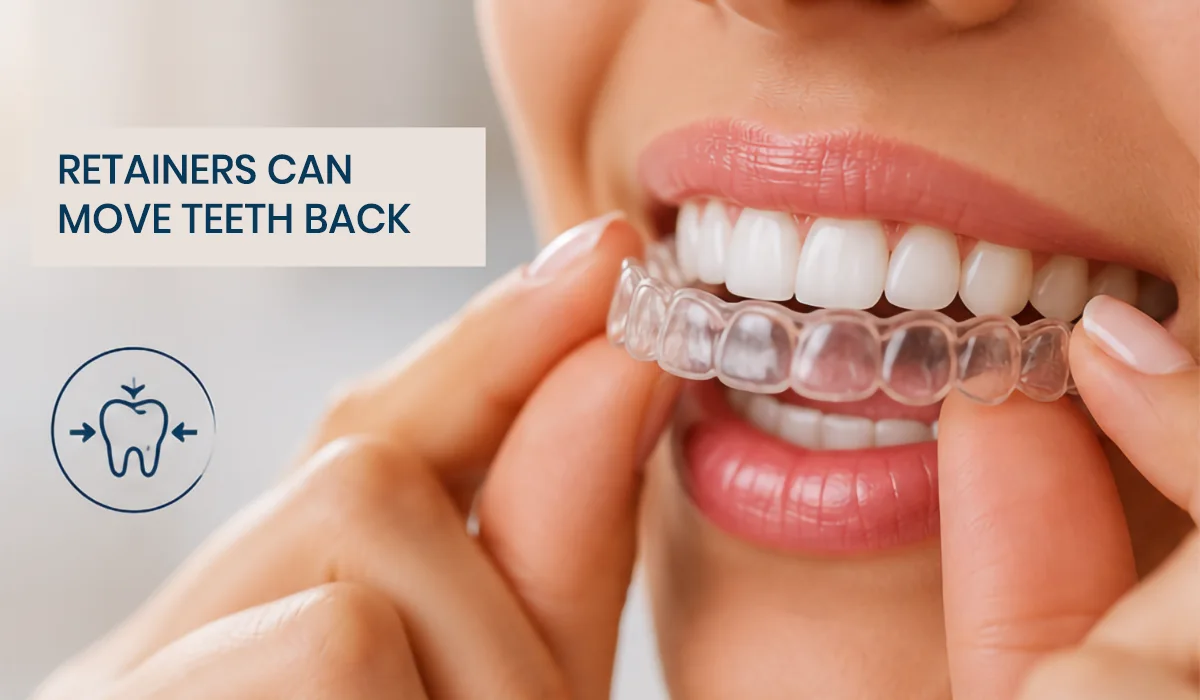 Woman placing a clear retainer over straight teeth after orthodontic treatment