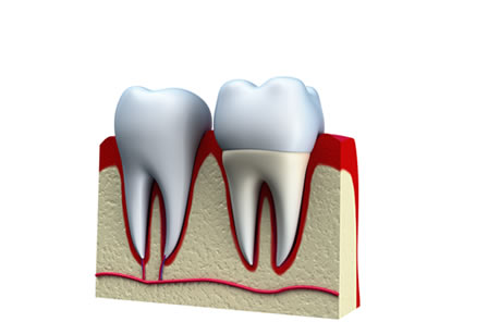 Dental Crowns