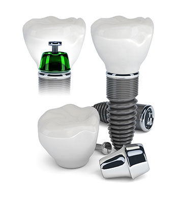 Dental Implants
